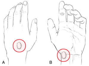 Ganglion Cyst Image